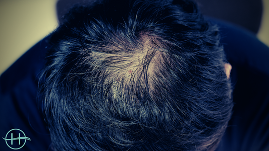4 Scientific Reasons for Common Hair Loss | Herbal Hair